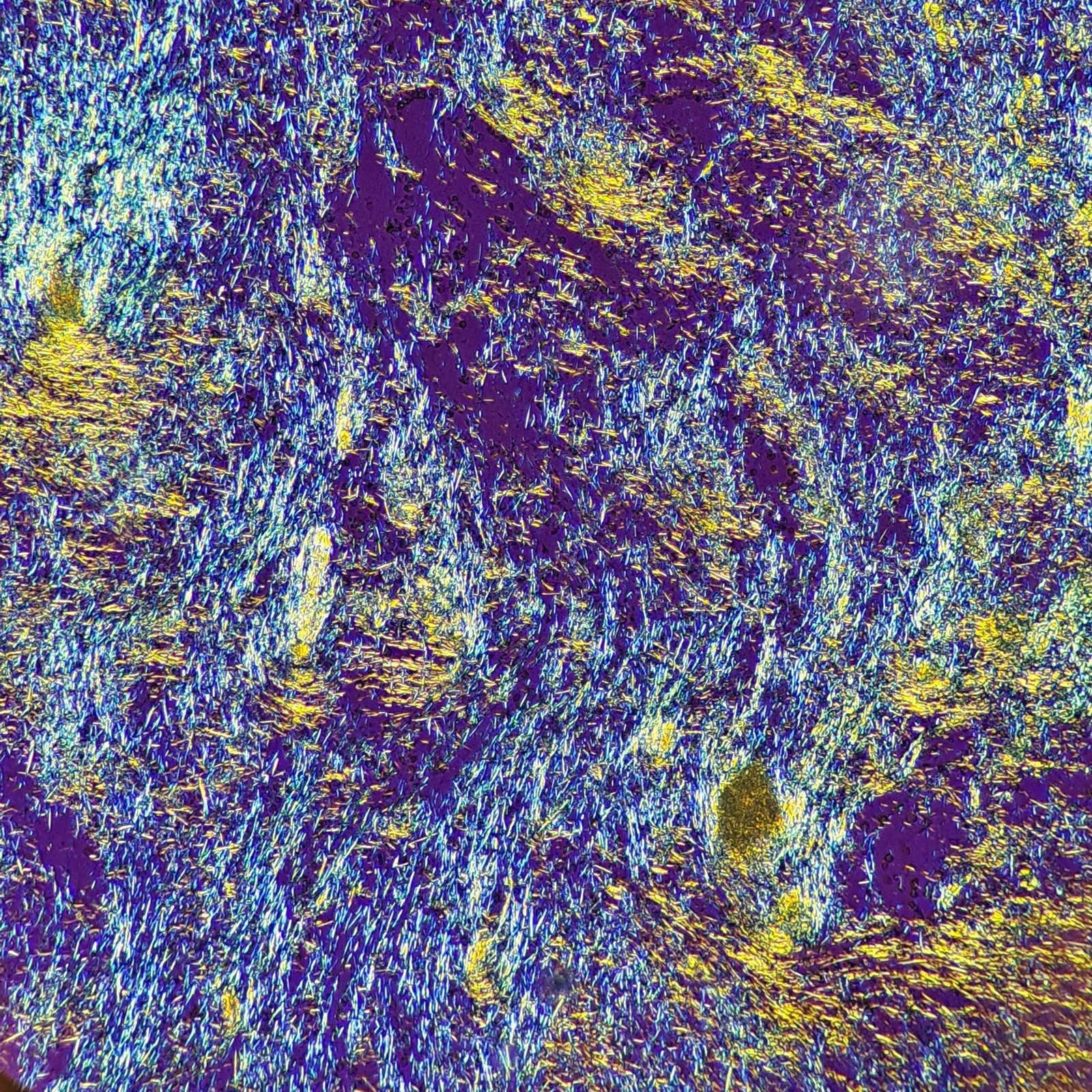 Gout Crystals in Body Fluid