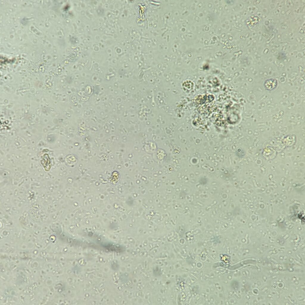 Urine Microscopic with 5-10 white blood cells and 4+ bacteria