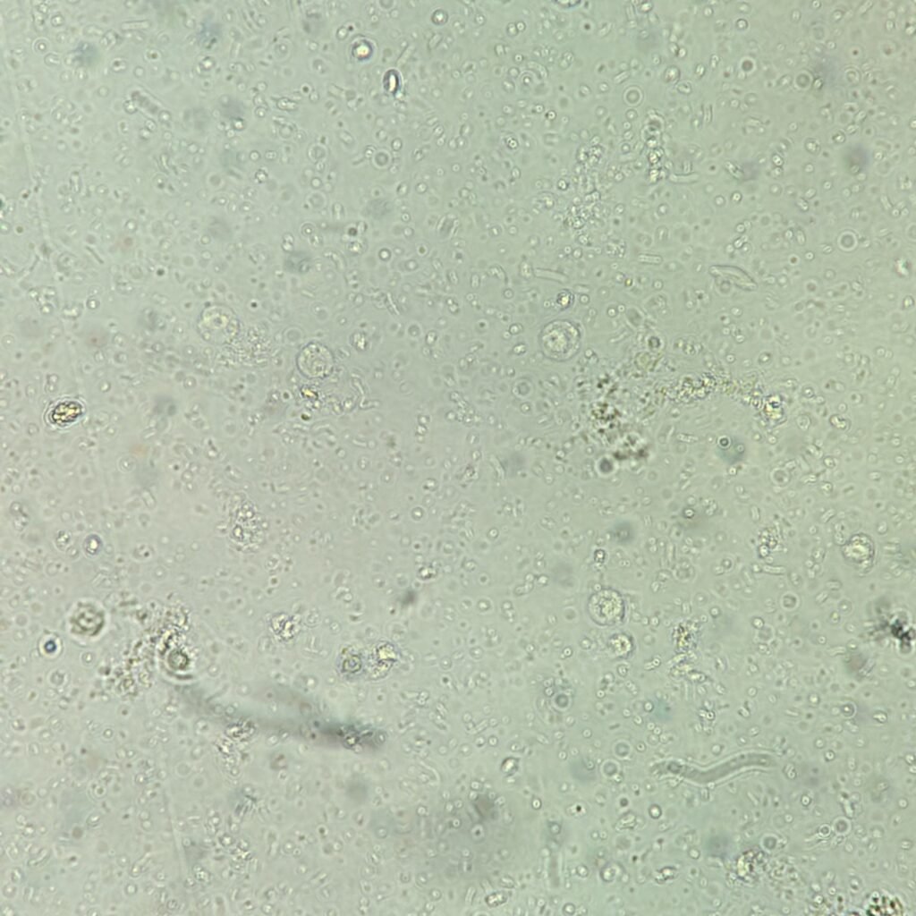 Urine Microscopic with 5-10 white blood cells and 4+ bacteria