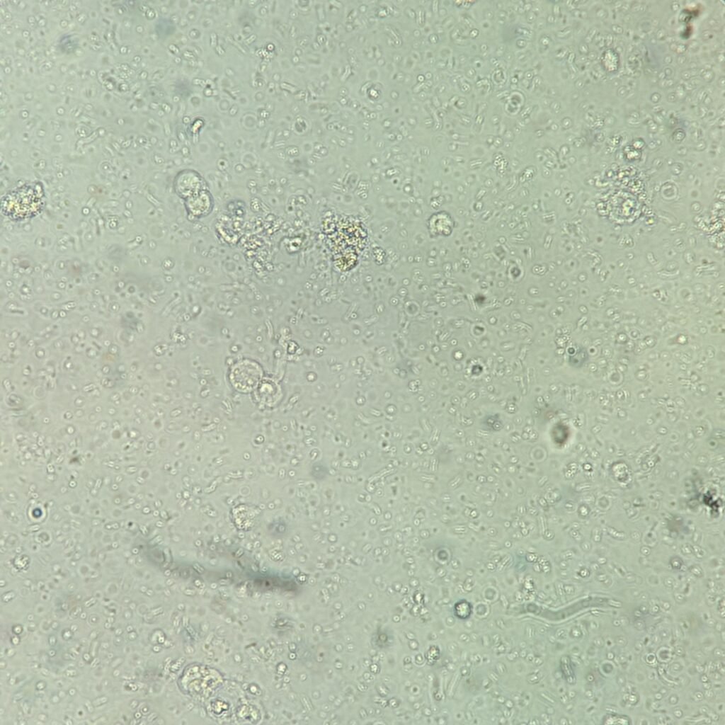 Urine Microscopic with 5-10 white blood cells and 4+ bacteria
