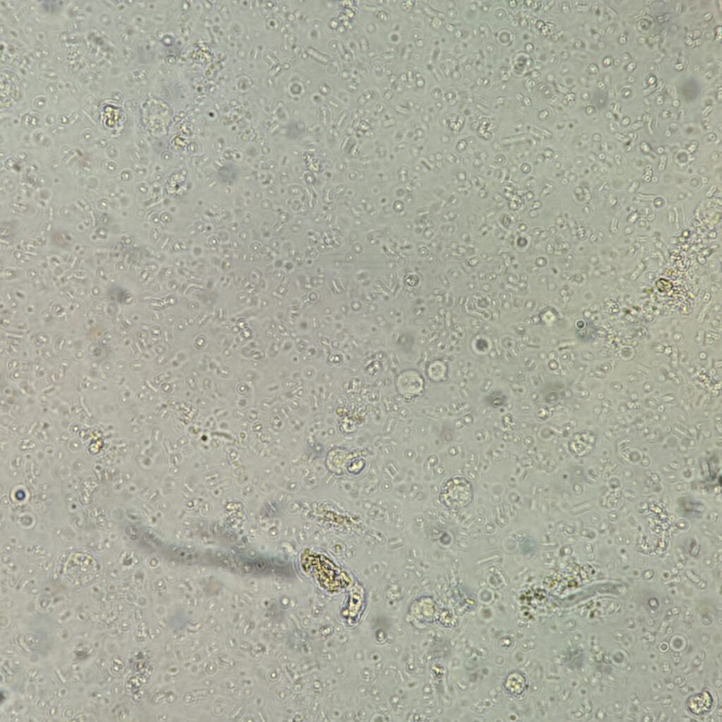 Urine Microscopic with 5-10 white blood cells and 4+ bacteria
