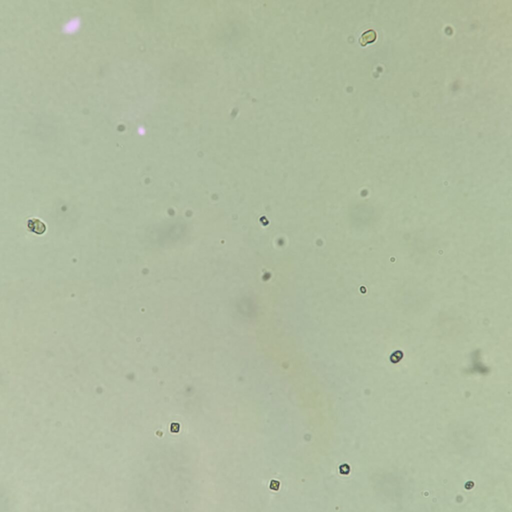 2 white blood cells, few bacteria, and few calcium oxalate crystals in urine