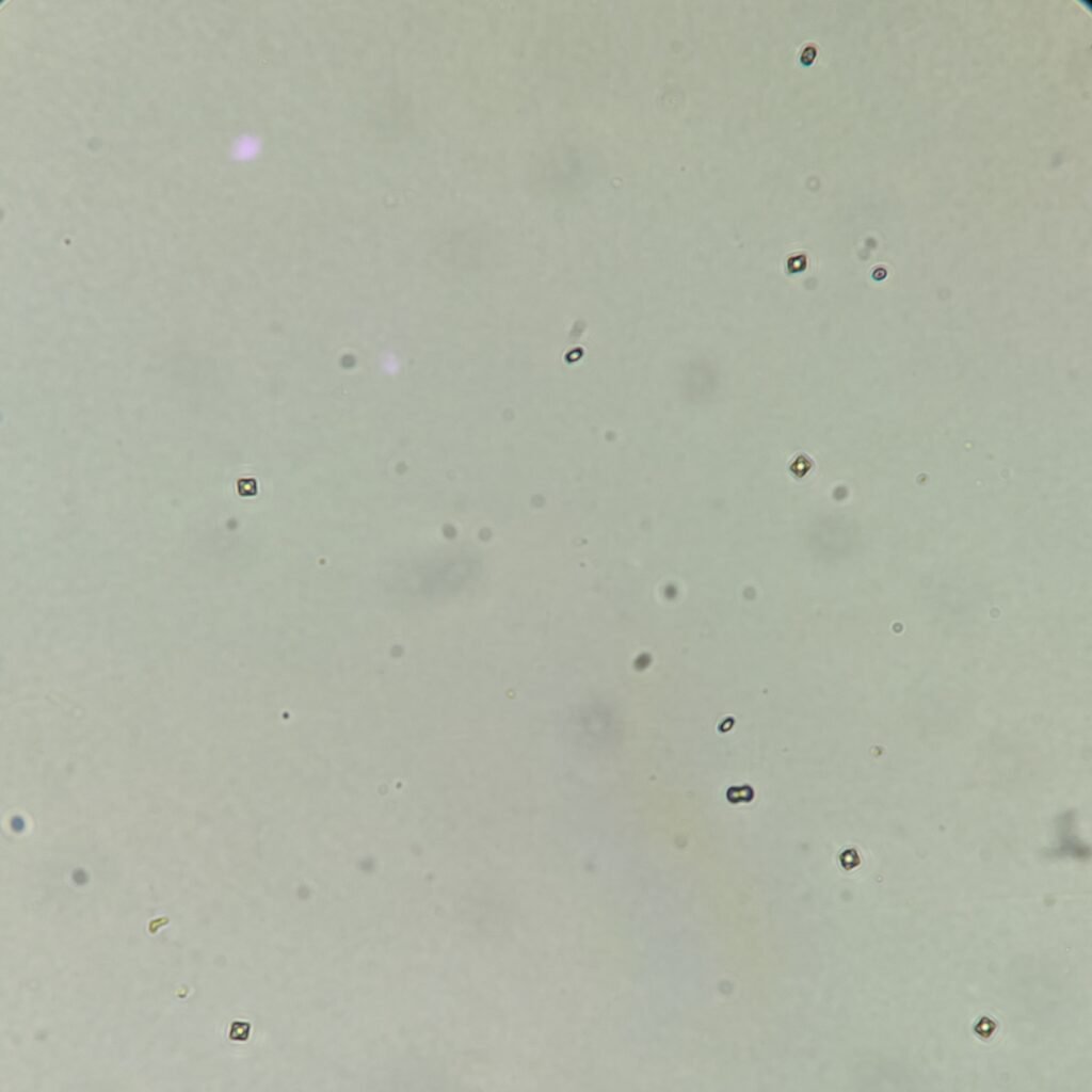 few bacteria and few calcium oxalate crystals in urine