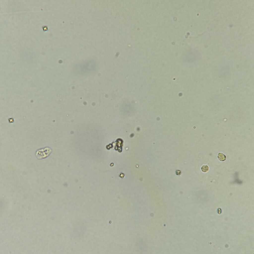 2 white blood cells, few bacteria, and few calcium oxalate crystals in urine