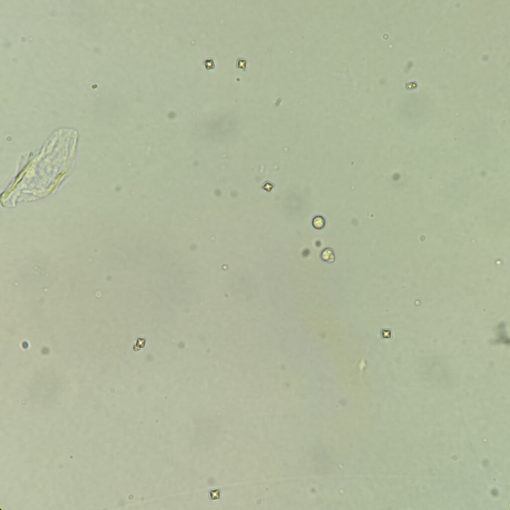 2 white blood cells, few bacteria, and few calcium oxalate crystals in urine