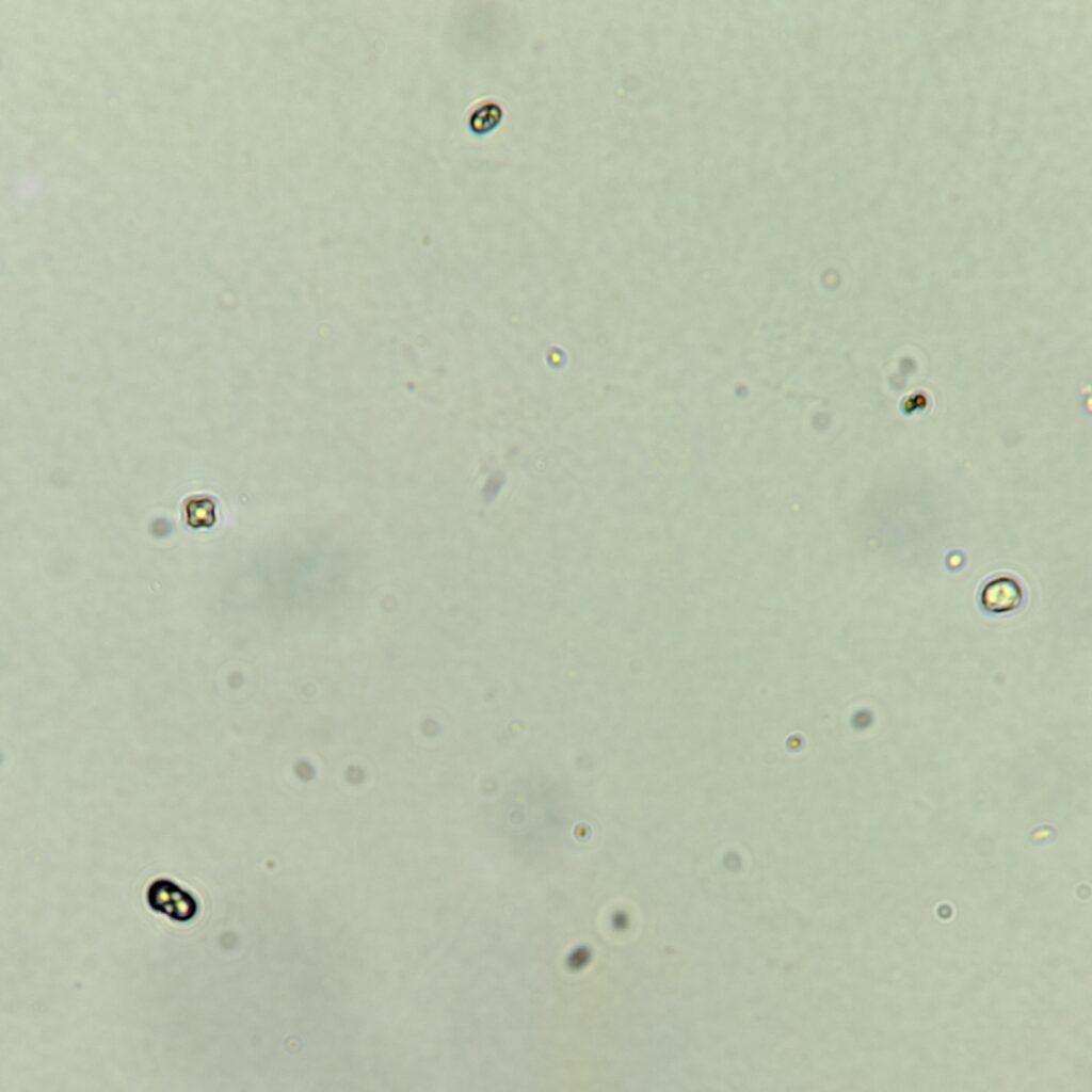 one white blood cell, few bacteria, and few calcium oxalate crystals in urine