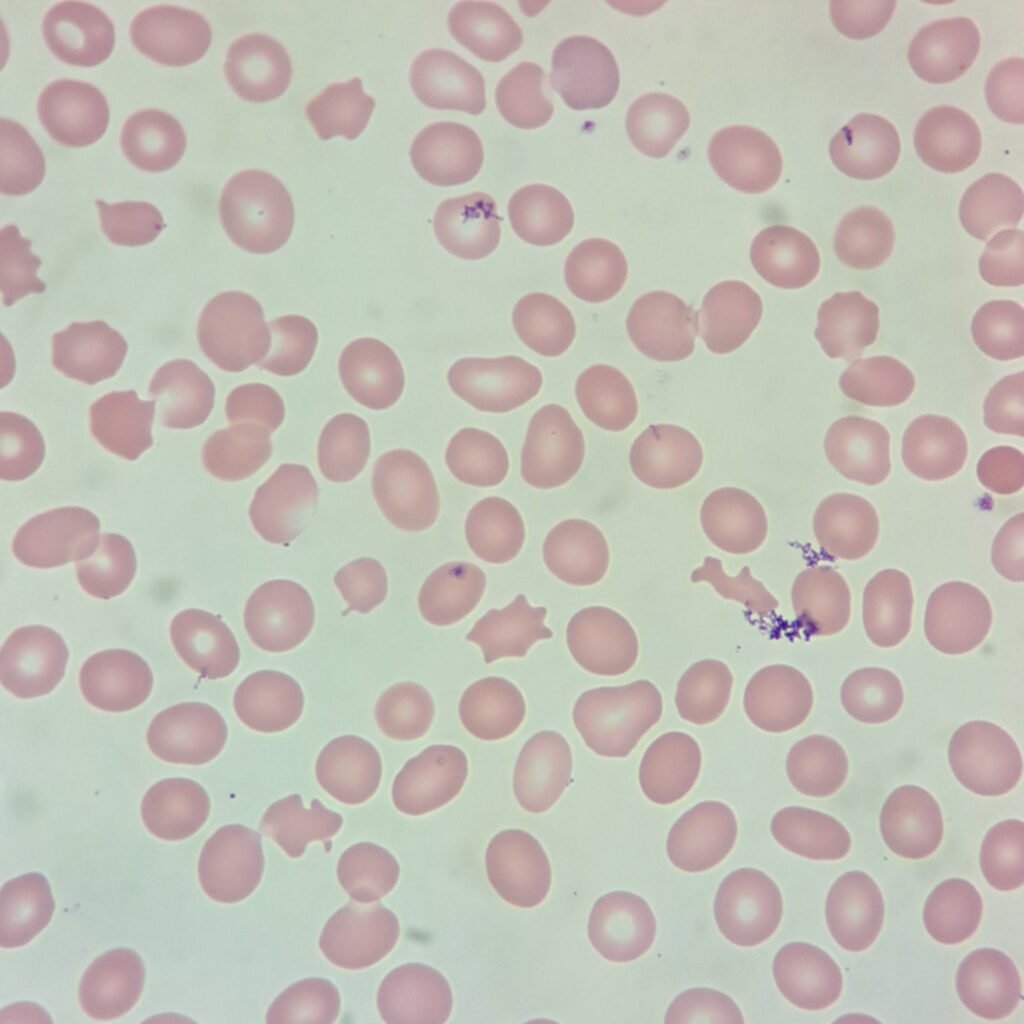 Acanthocytes
