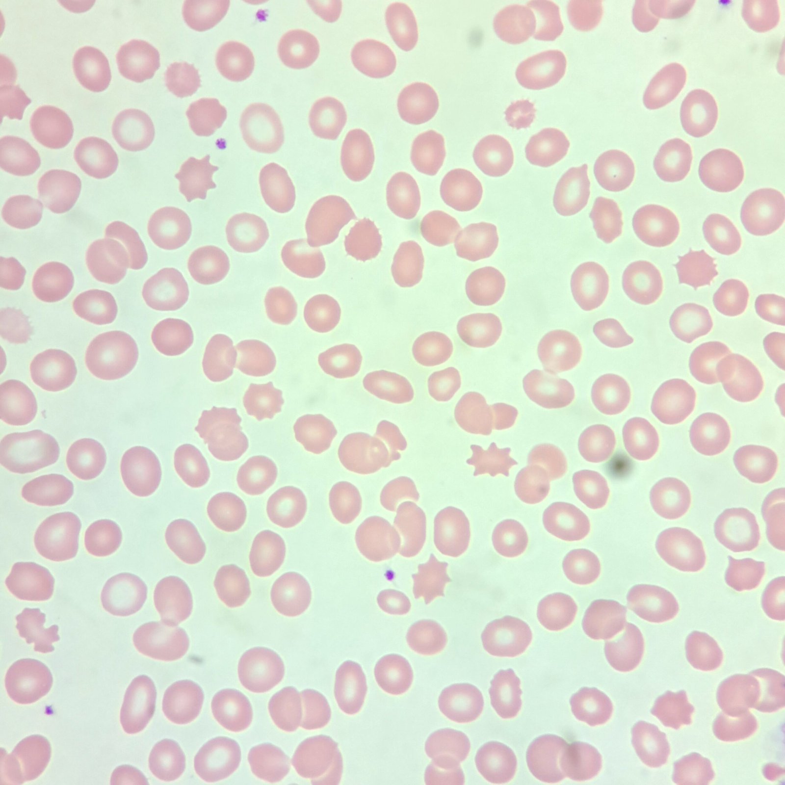 Acanthocytes, Red Blood Cell Morphology