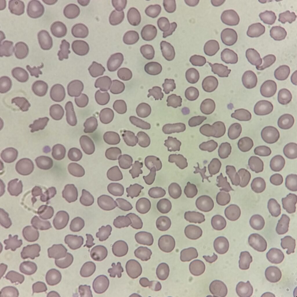Acanthocytes