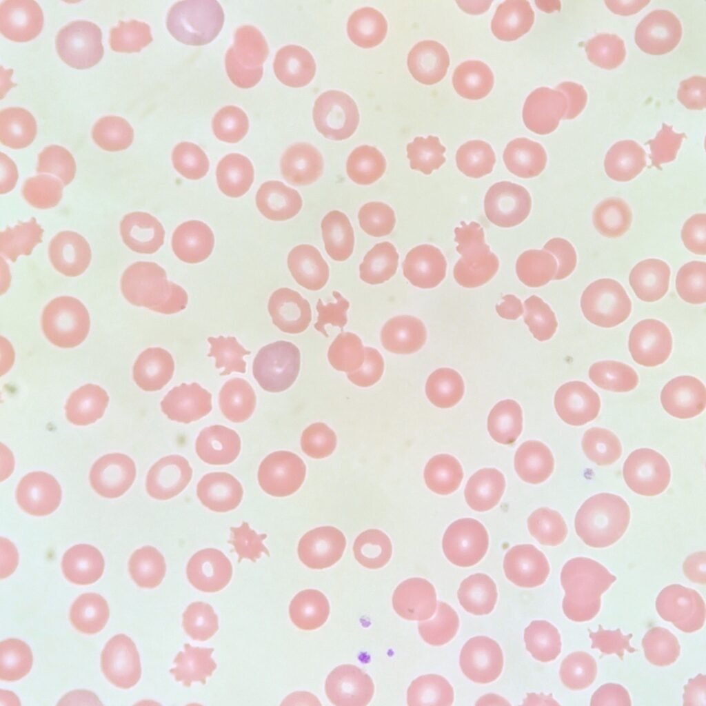 acanthocyte red blood cell morphology