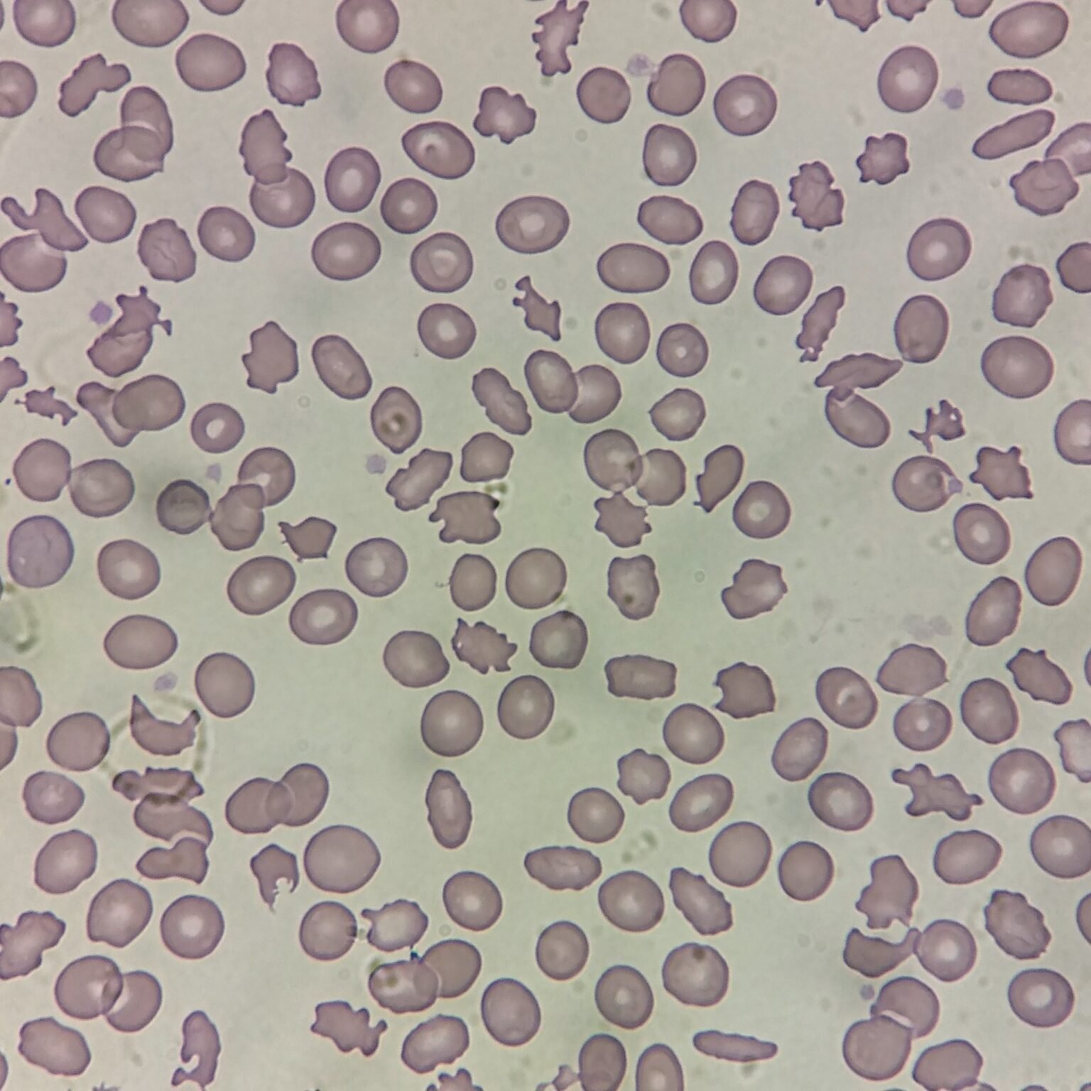 RBC Morphology Based on Shape