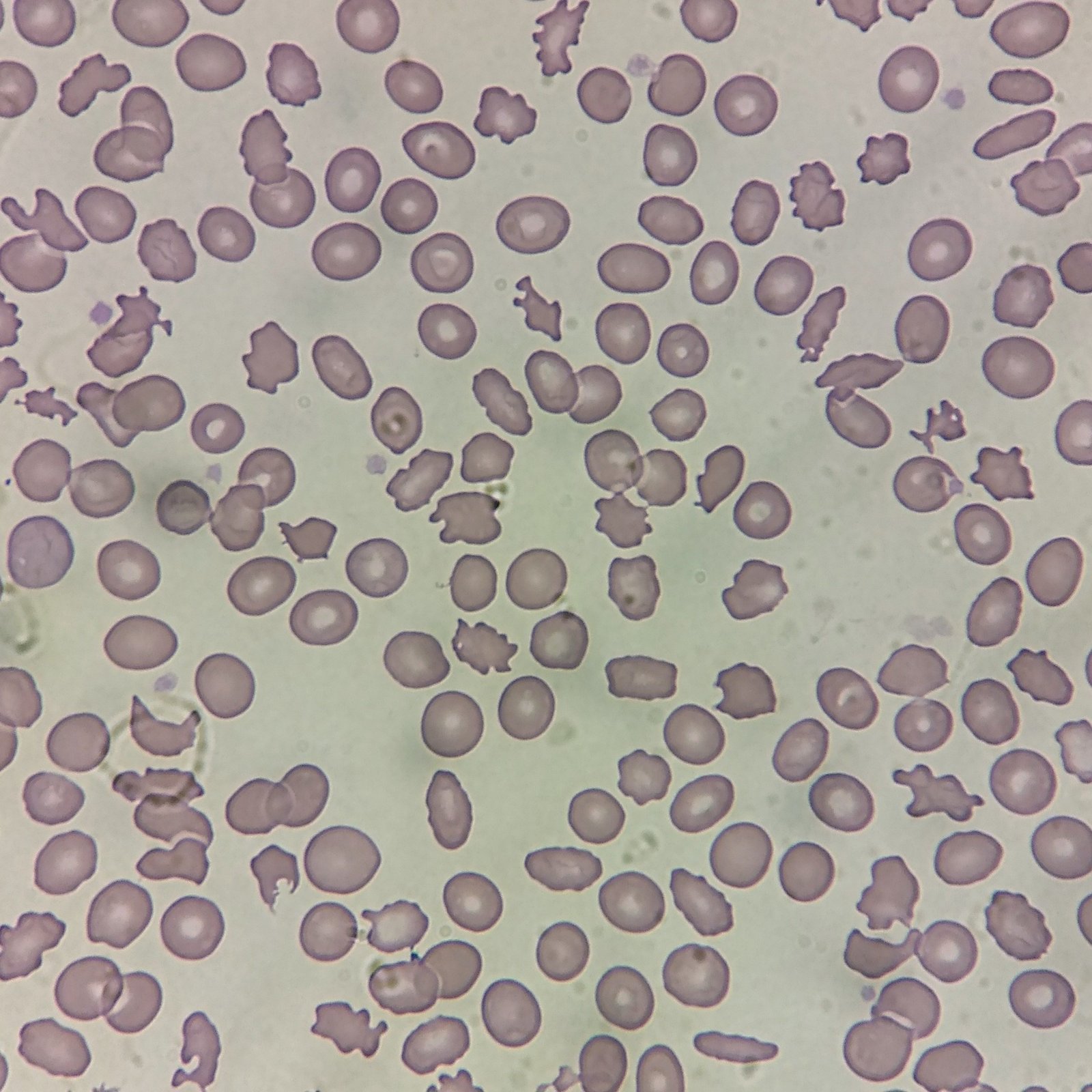 Acanthocytes