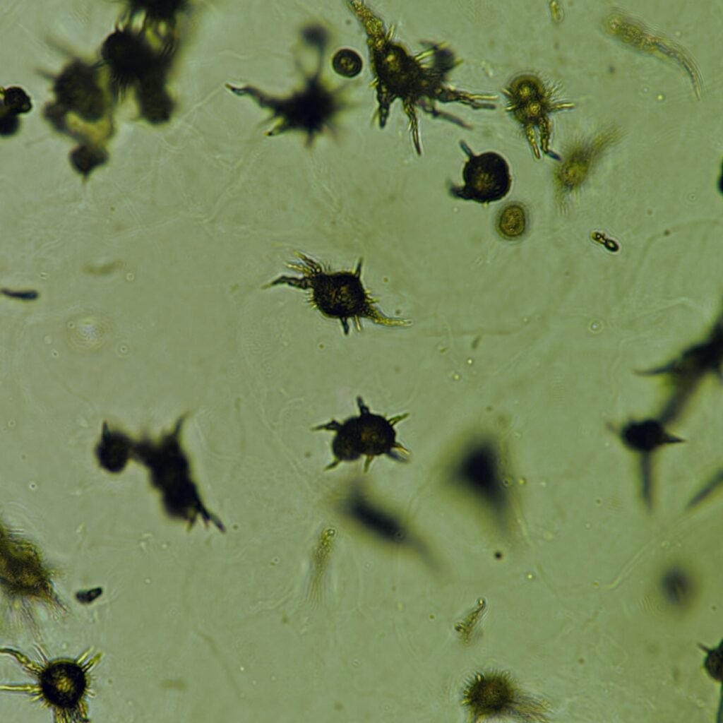 Ammonium Biurate Crystals in urine