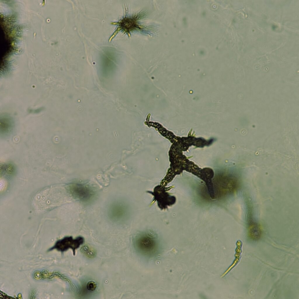 Ammonium Biurate Crystals in urine