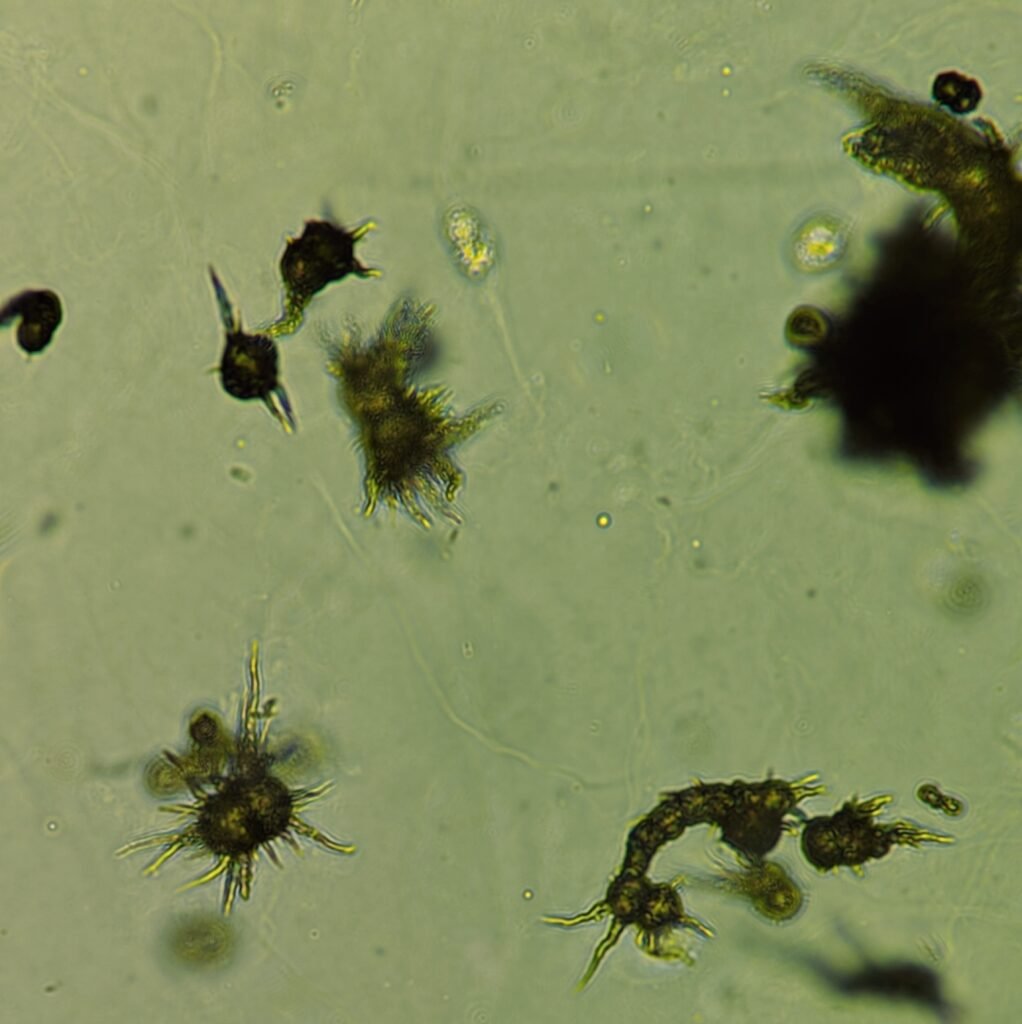 Ammonium Biurate Crystals in urine