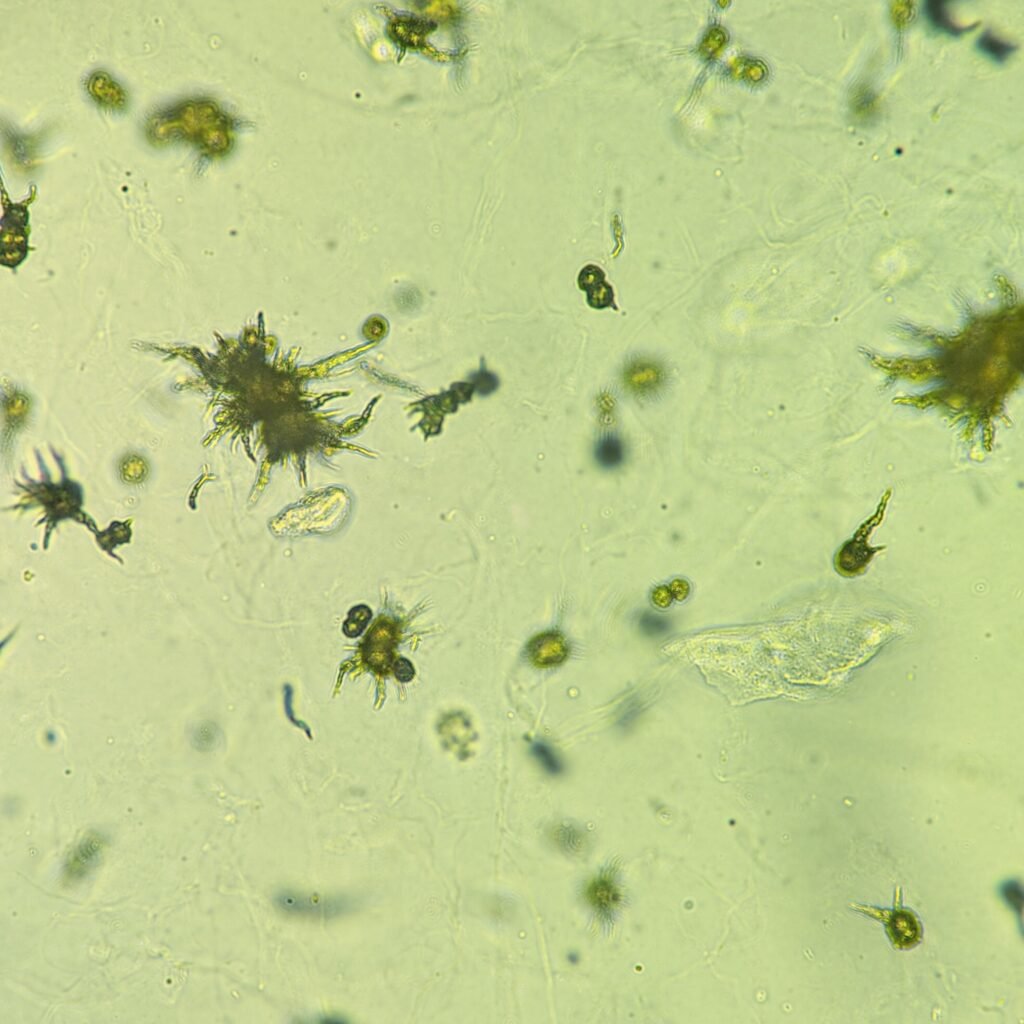 Ammonium Biurate Crystals in urine