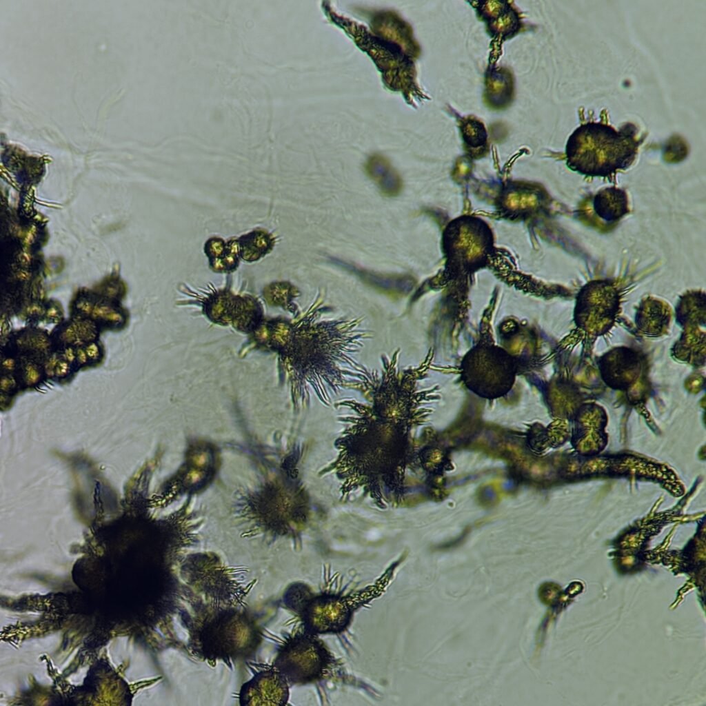 Ammonium Biurate Crystals in urine