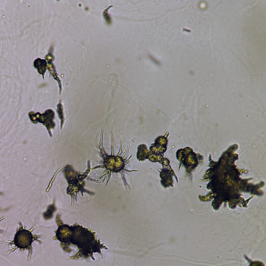 Ammonium Biurate Crystals in urine