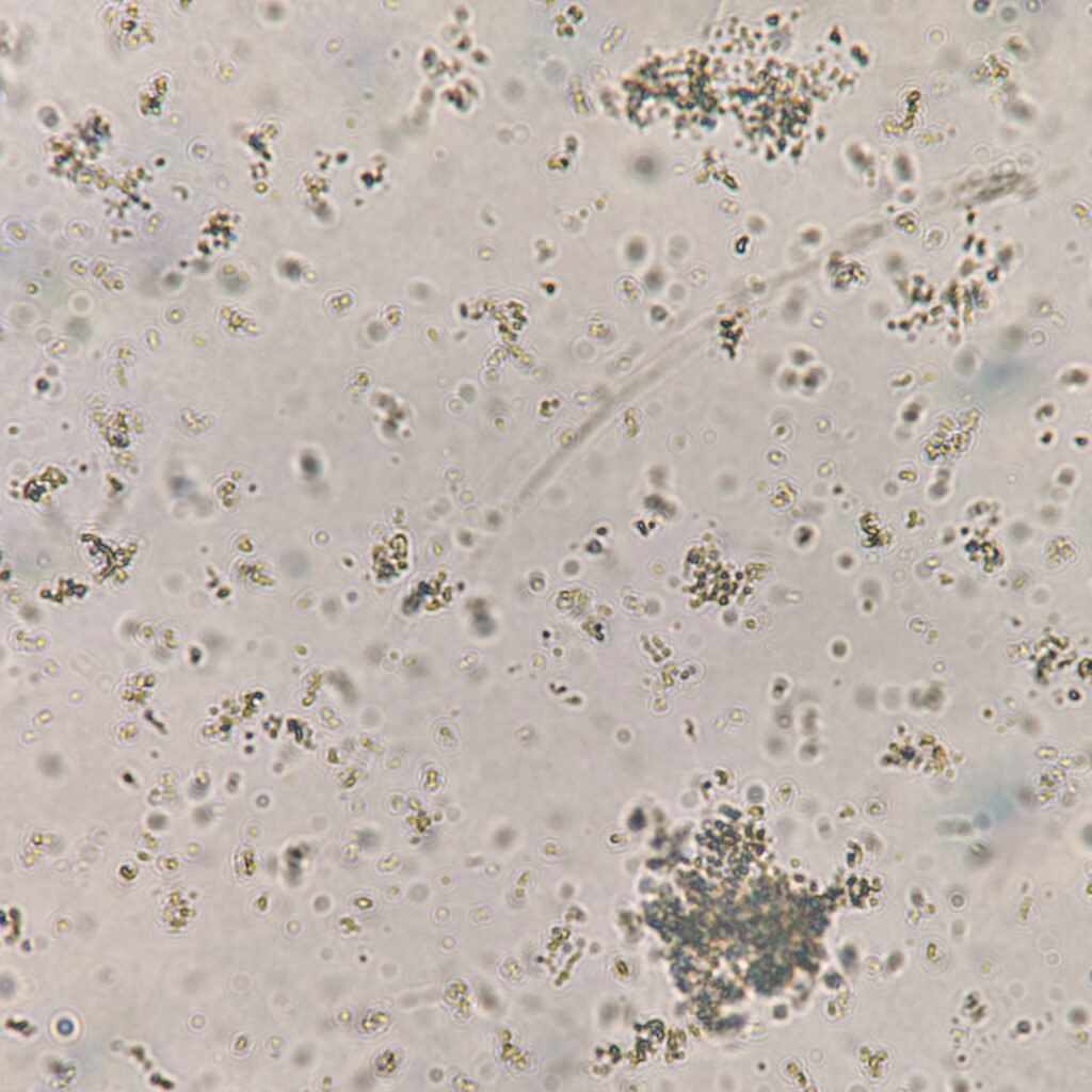 Amorphous phosphate crystals in urine microscopic