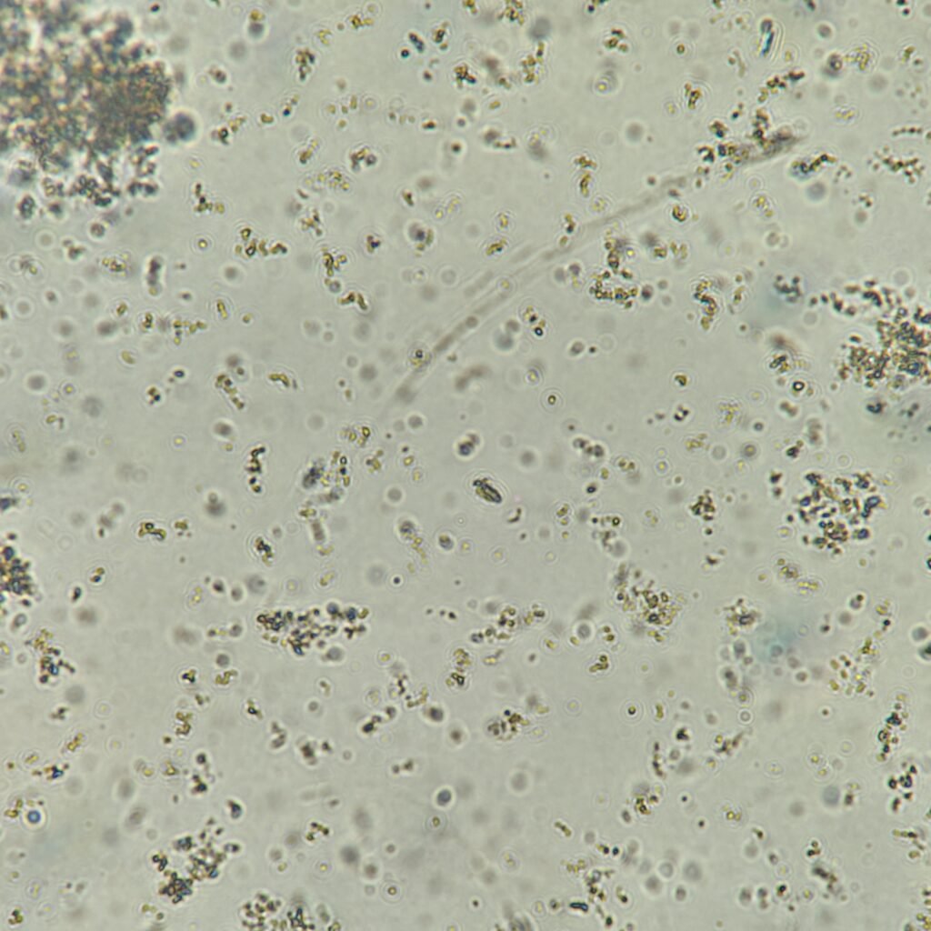 Amorphous phosphate crystals in urine microscopic