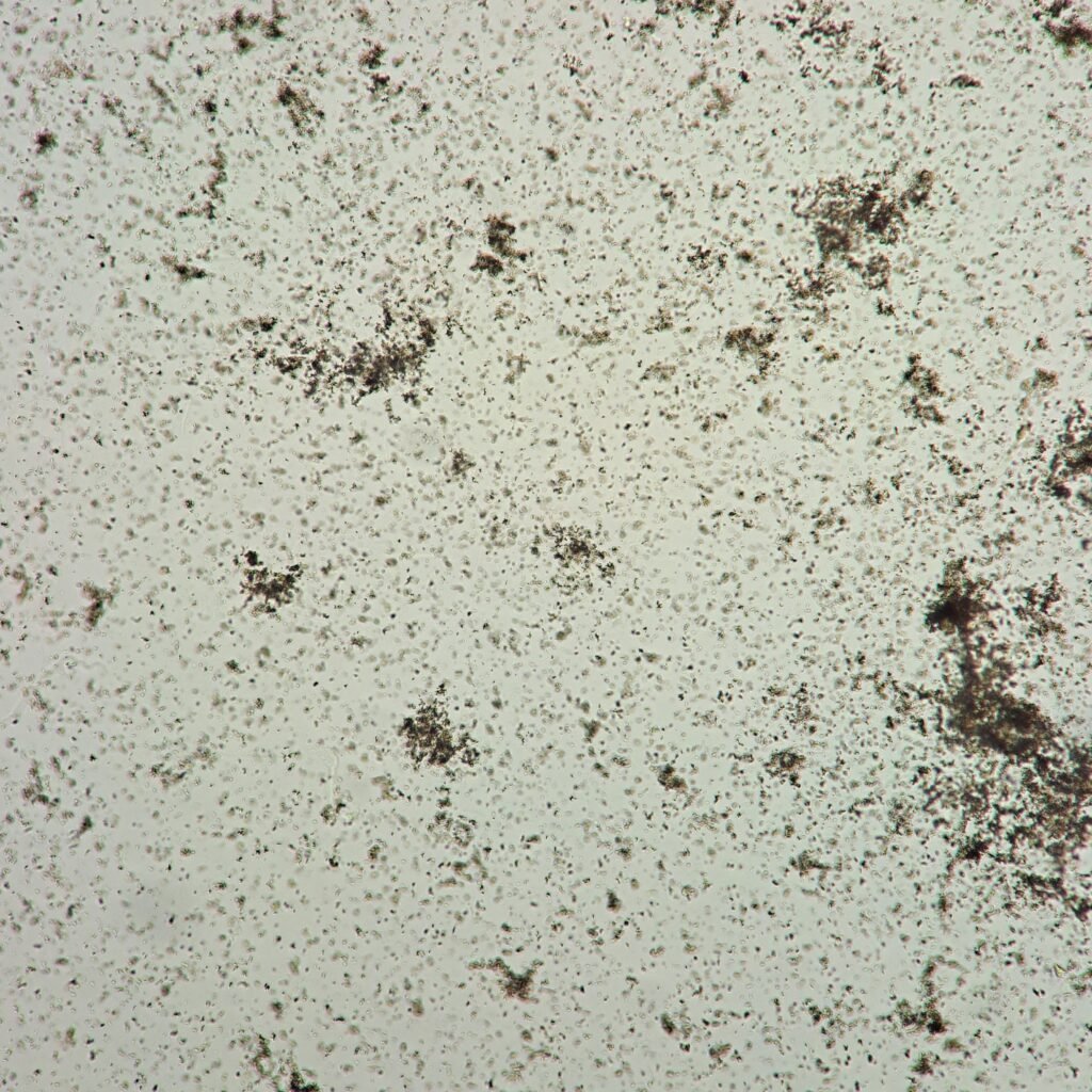 amorphous urates