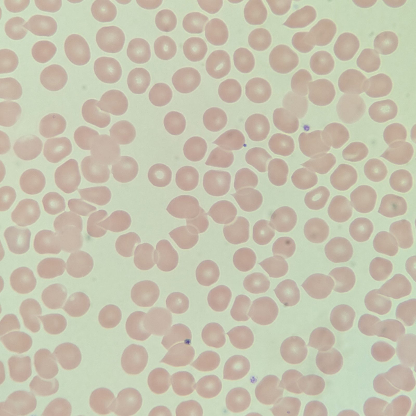 Artifactual teardrops, red blood cell morphology