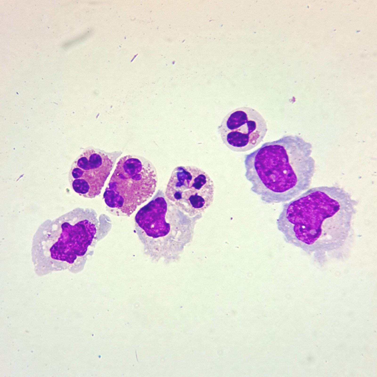 body-fluid-eosinophils-medlabbuddy