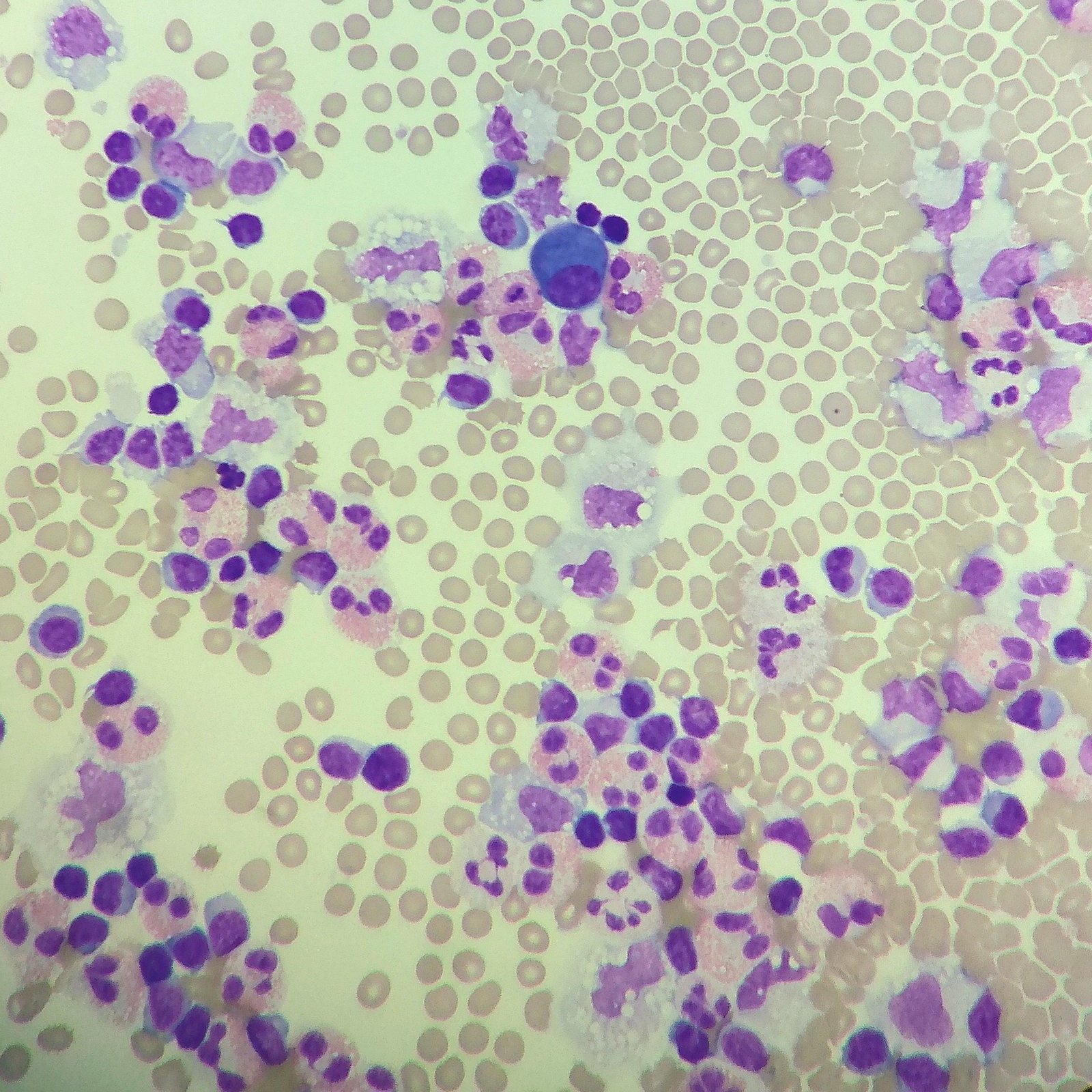 eosinophils in body fluid