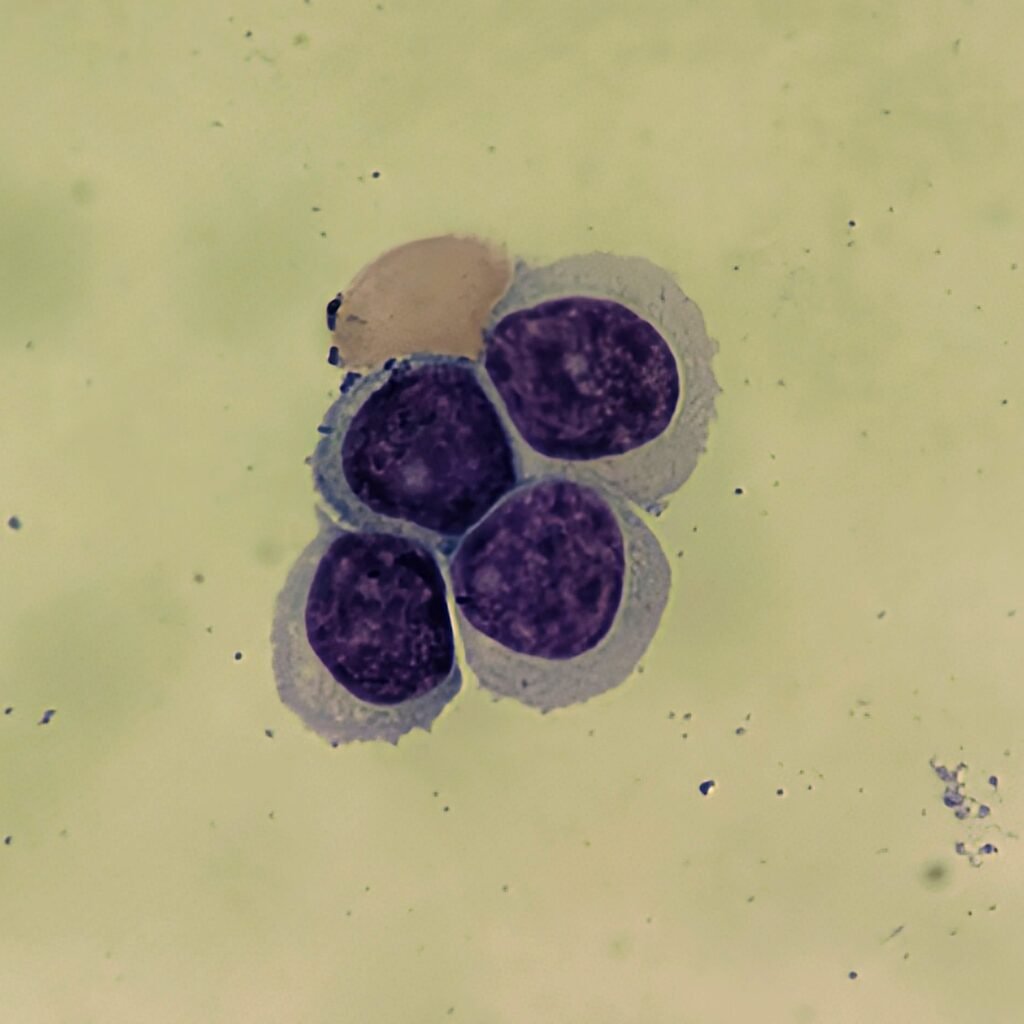 Lymphocytes in body fluid