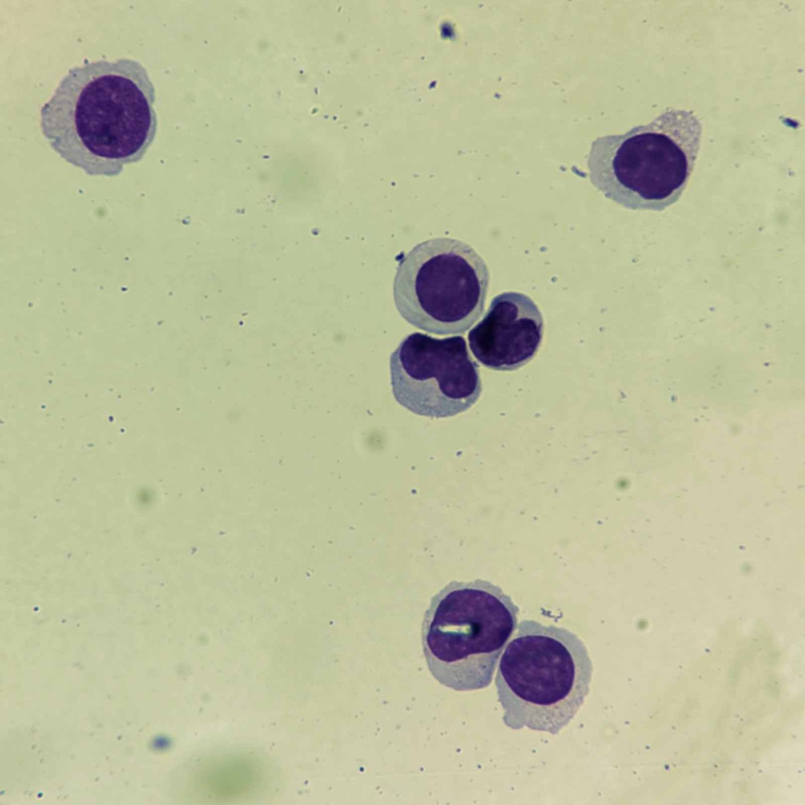 Lymphocytes in body fluid