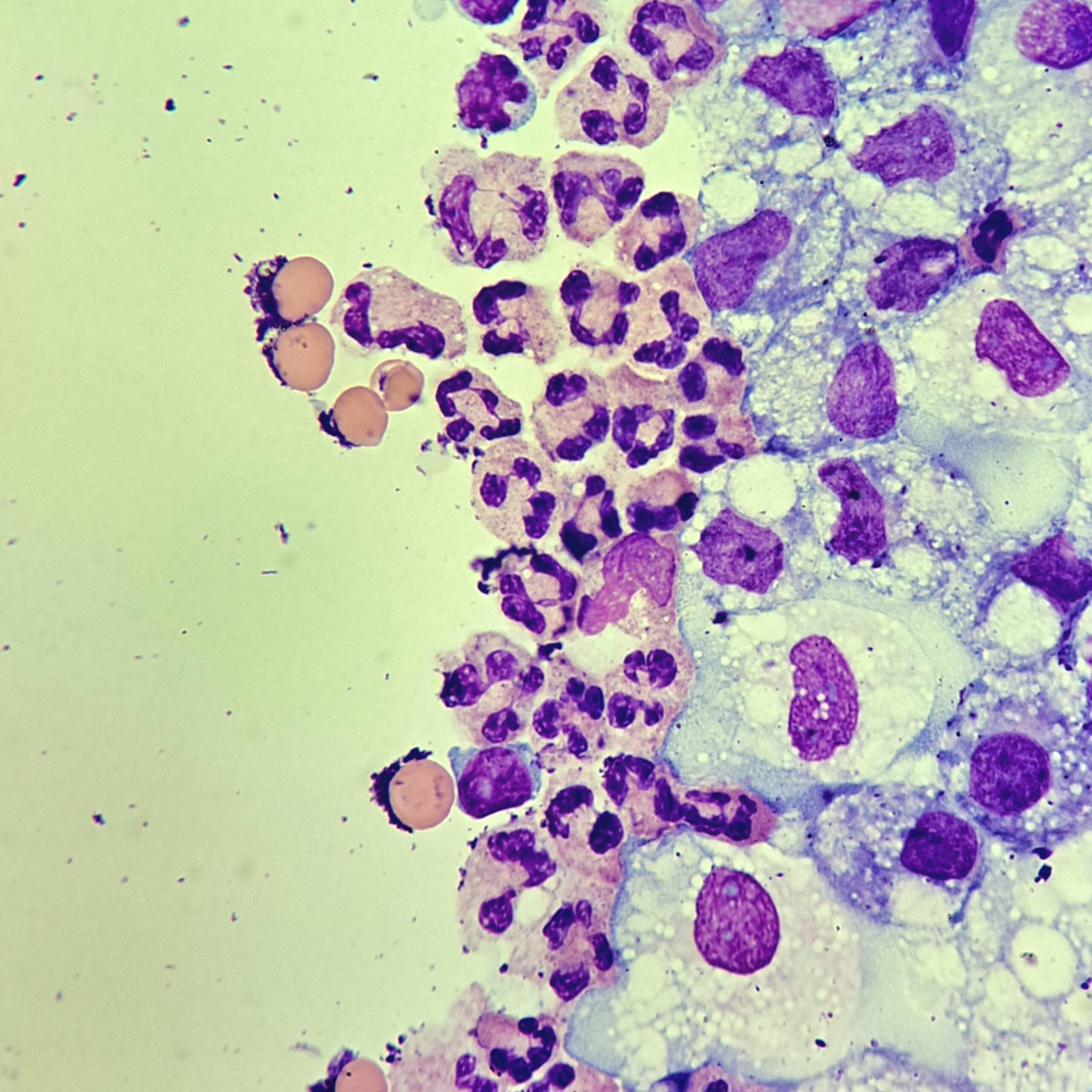 neutrophils in body fluid
