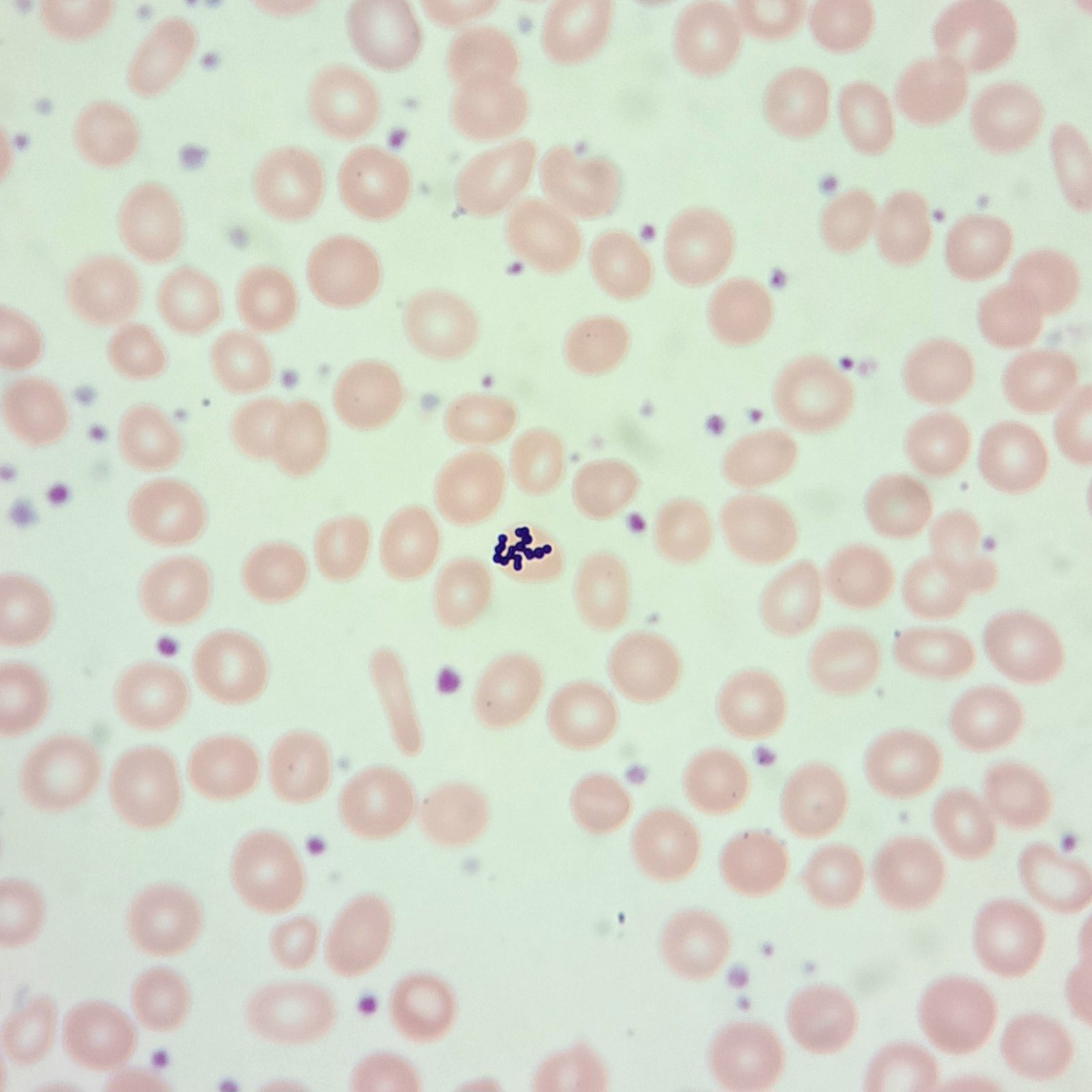 Bacterial contamination in peripheral blood smear
