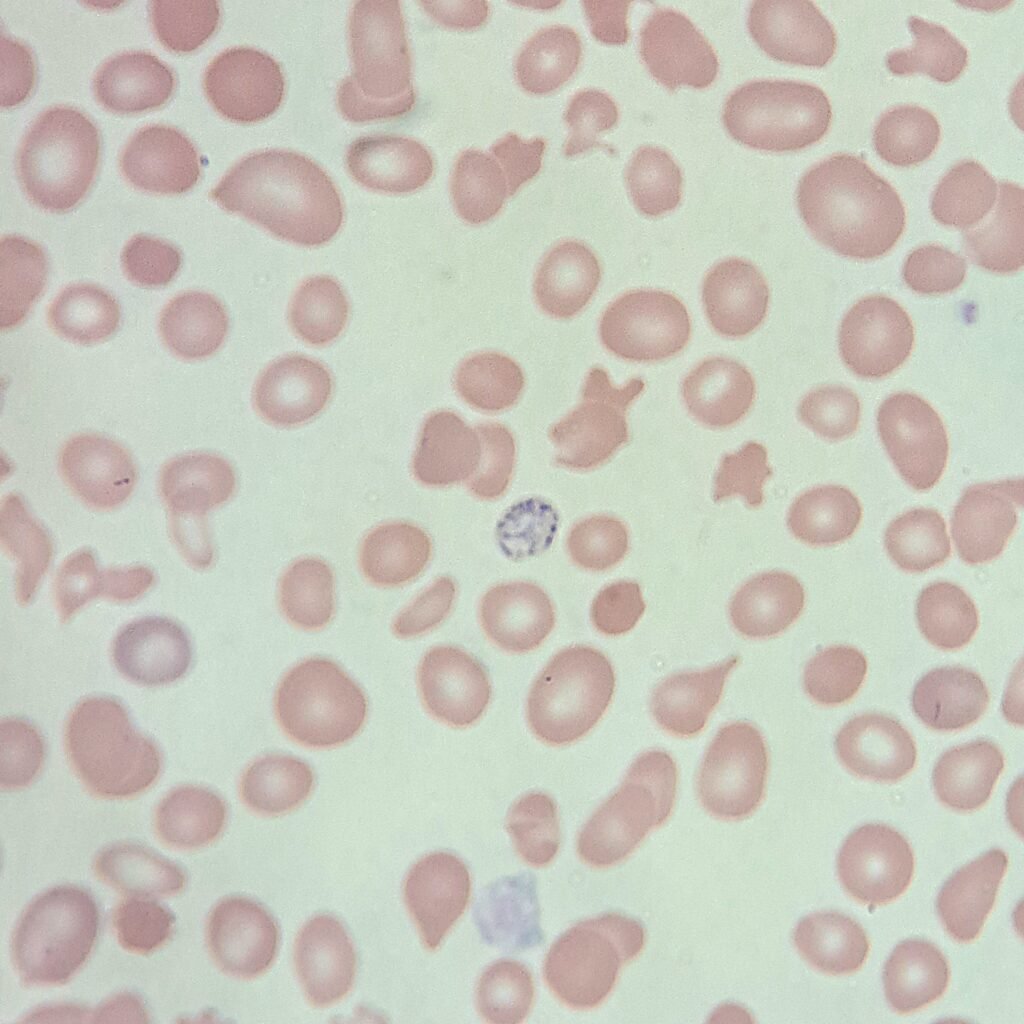 Coarse basophilic stippling in RBCs