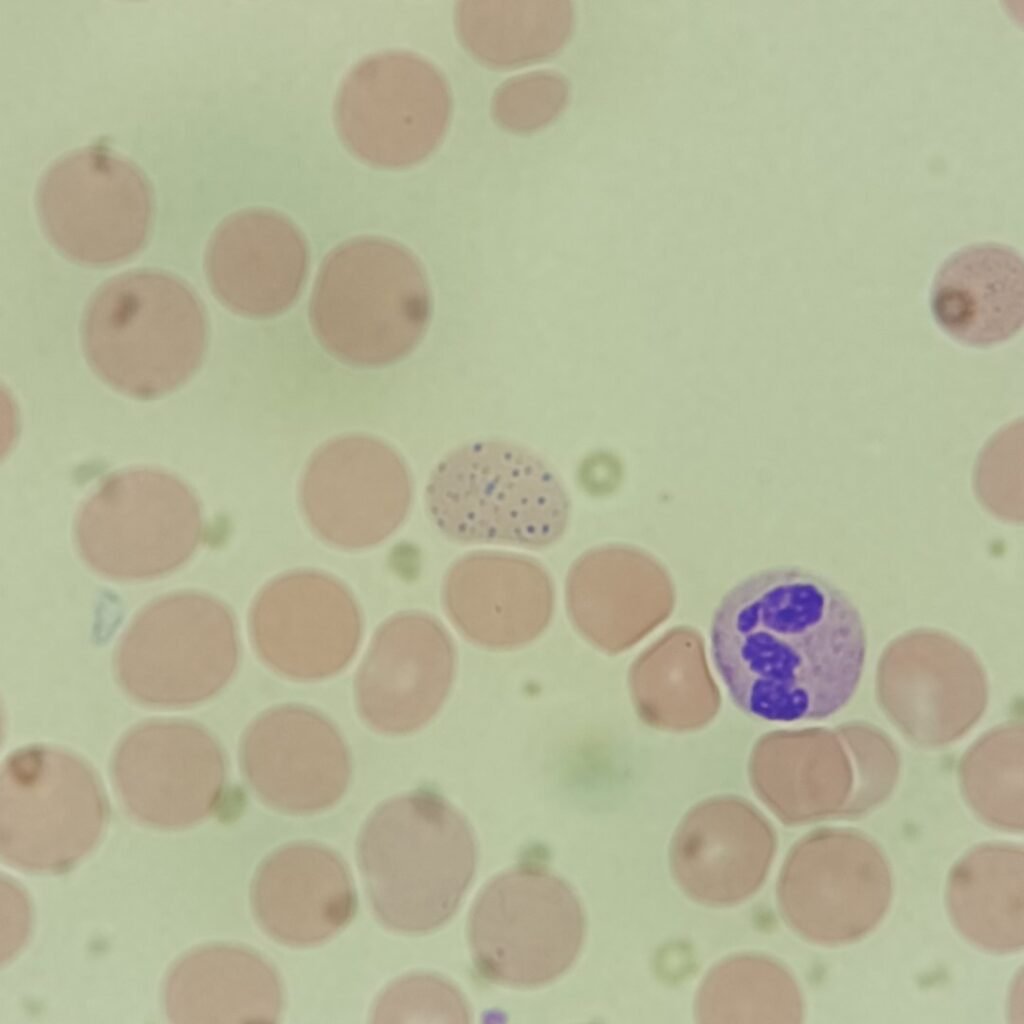 Coarse basophilic stippling in RBCs
