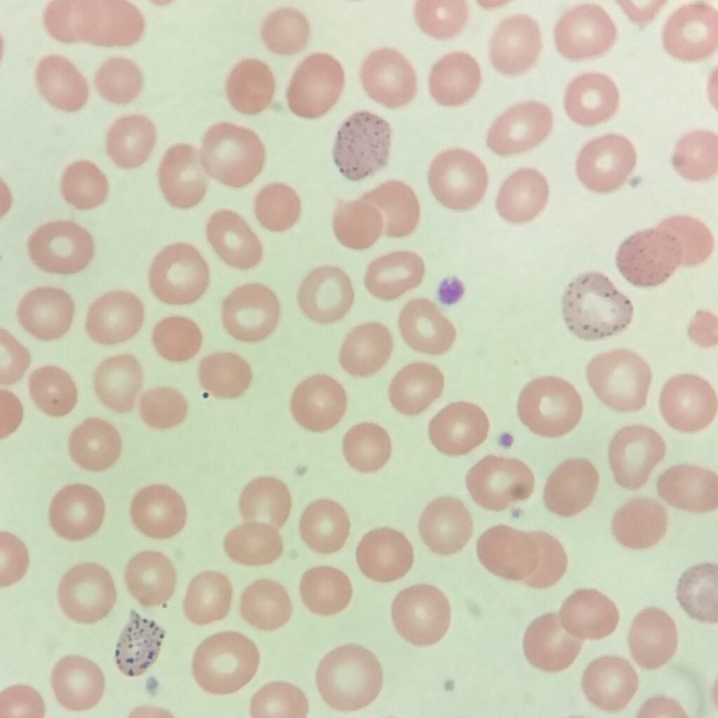 Coarse basophilic stippling in RBCs