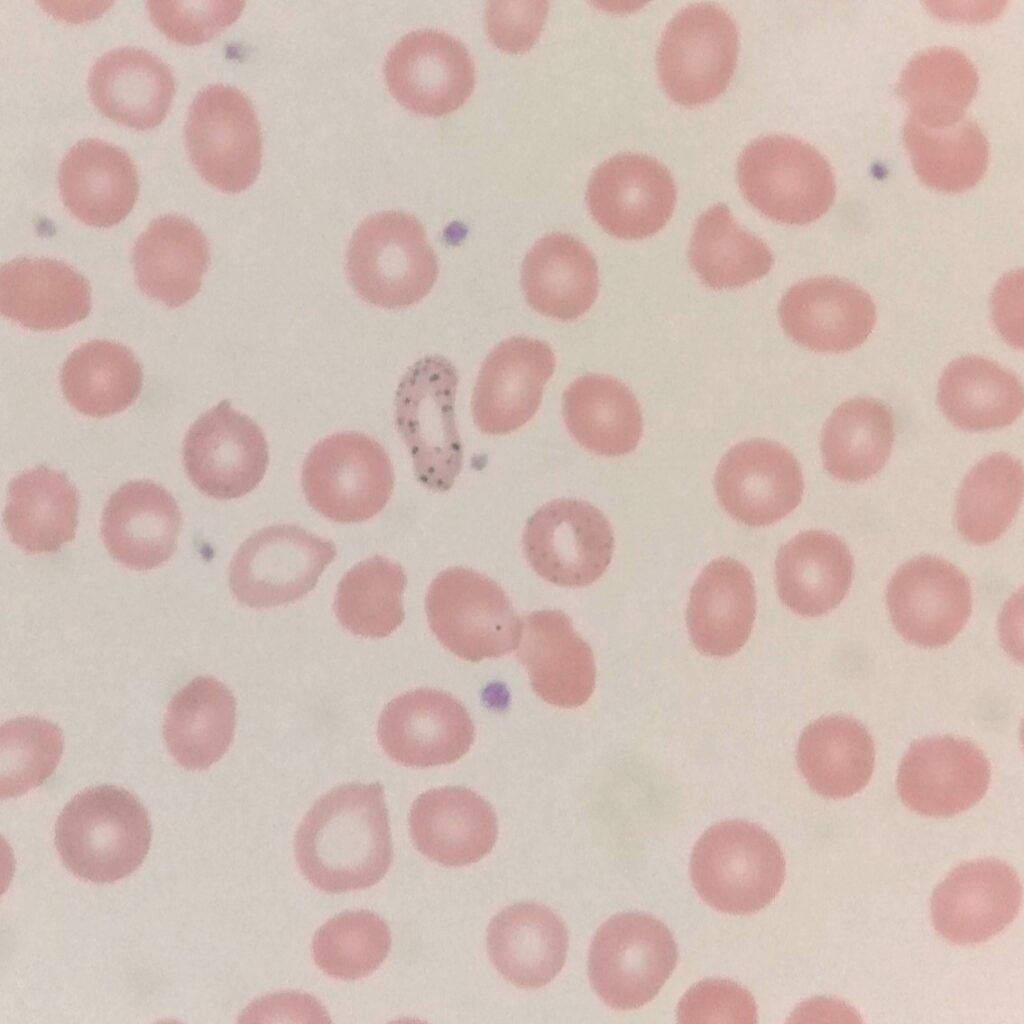 Coarse basophilic stippling in RBCs
