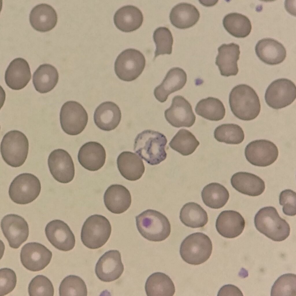 Coarse basophilic stippling in RBCs