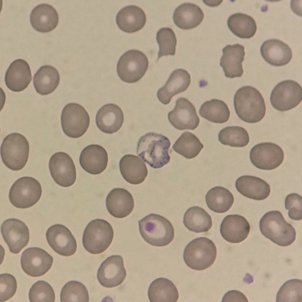 Coarse Basophilic Stippling, red blood cell inclusions
