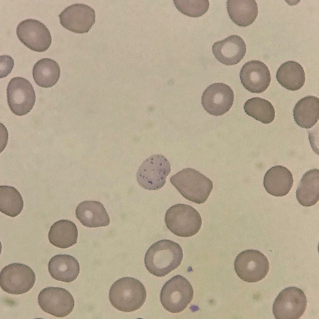 Coarse basophilic stippling in RBCs