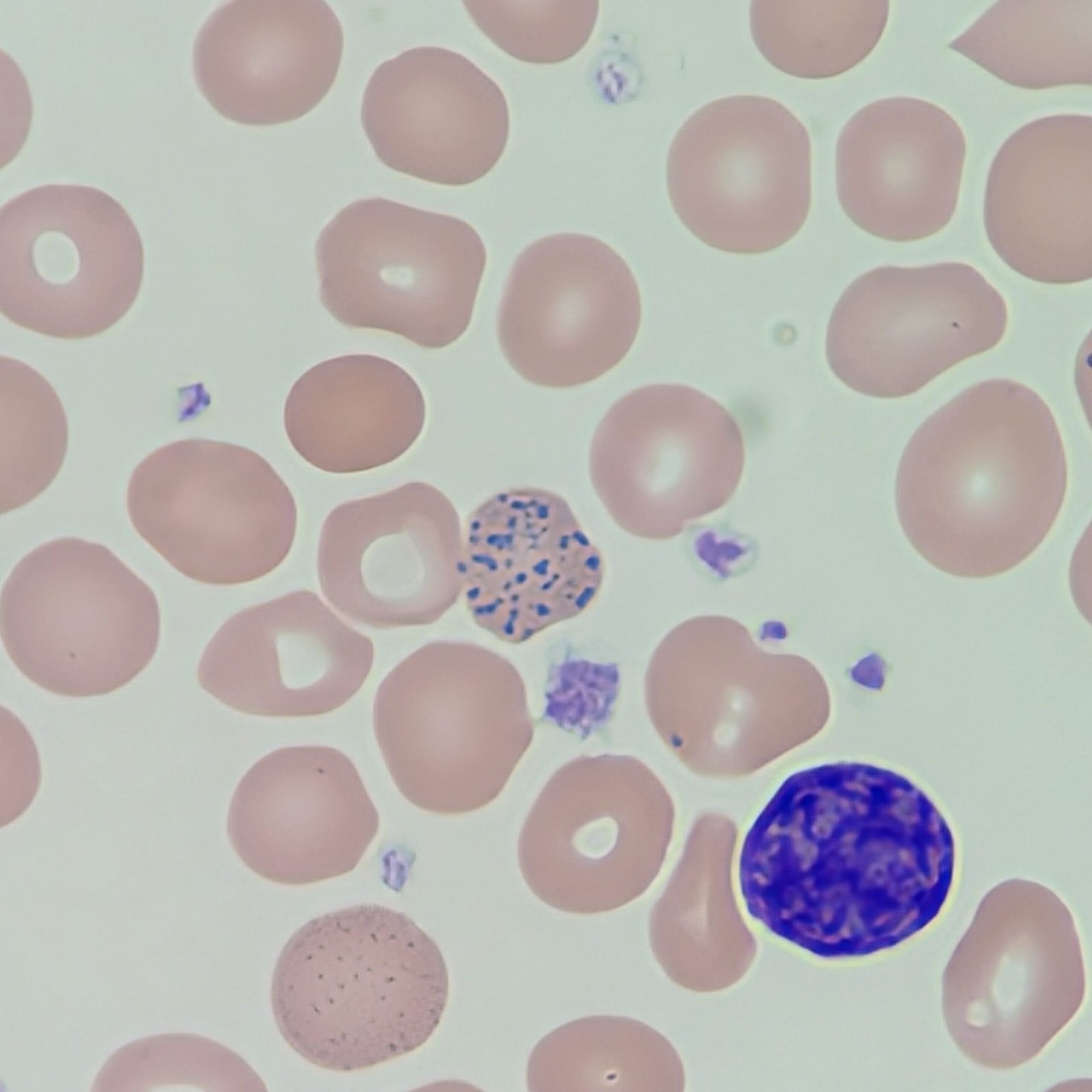 Coarse Basophilic Stippling, red blood cell inclusions