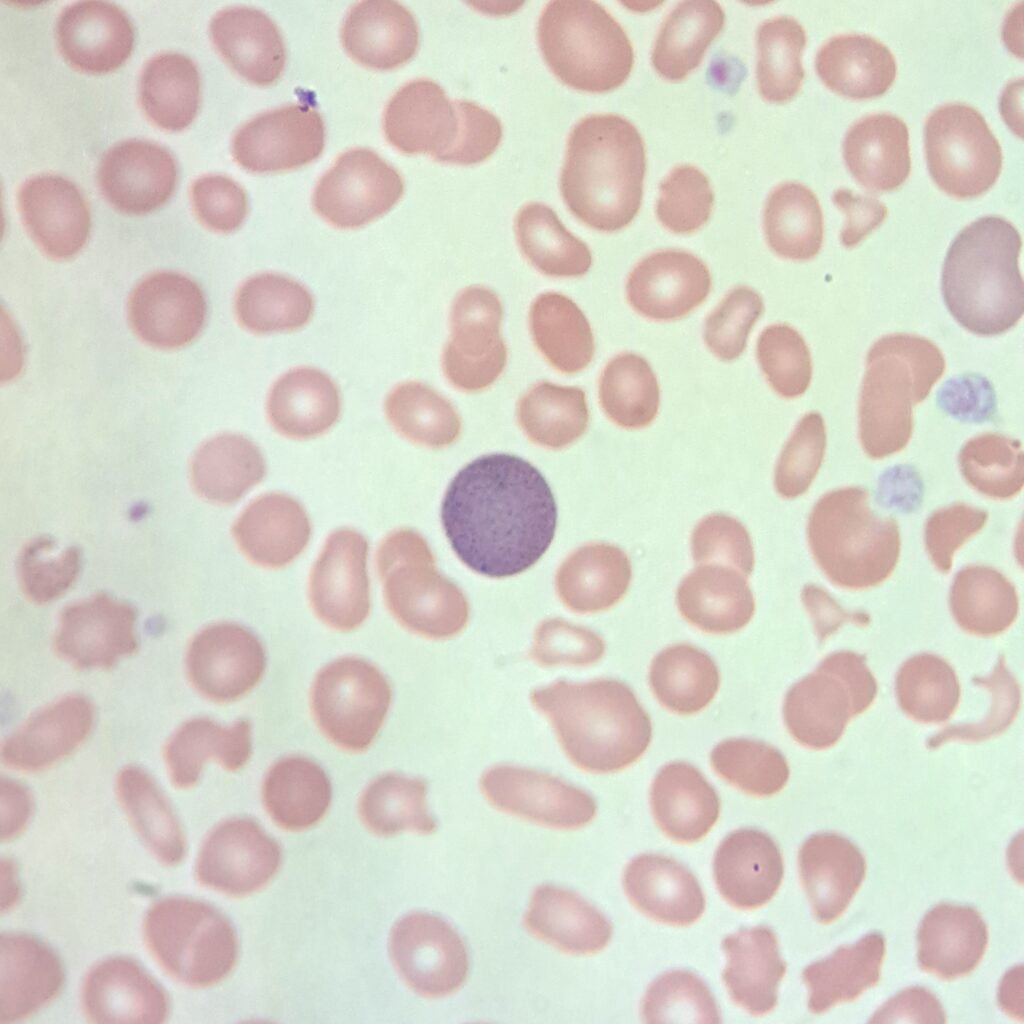 Fine basophilic stippling in polychromatophilic RBC