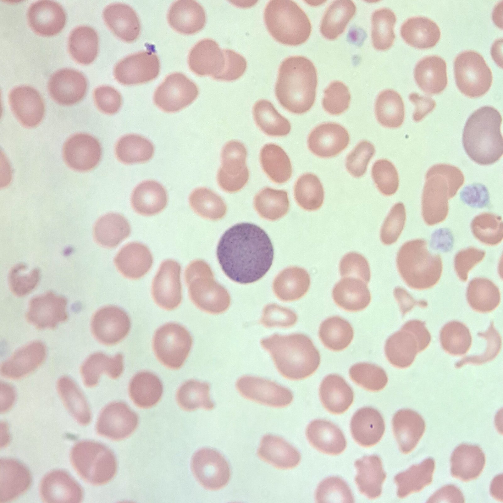Fine Basophilic Stippling, red blood cell inclusions