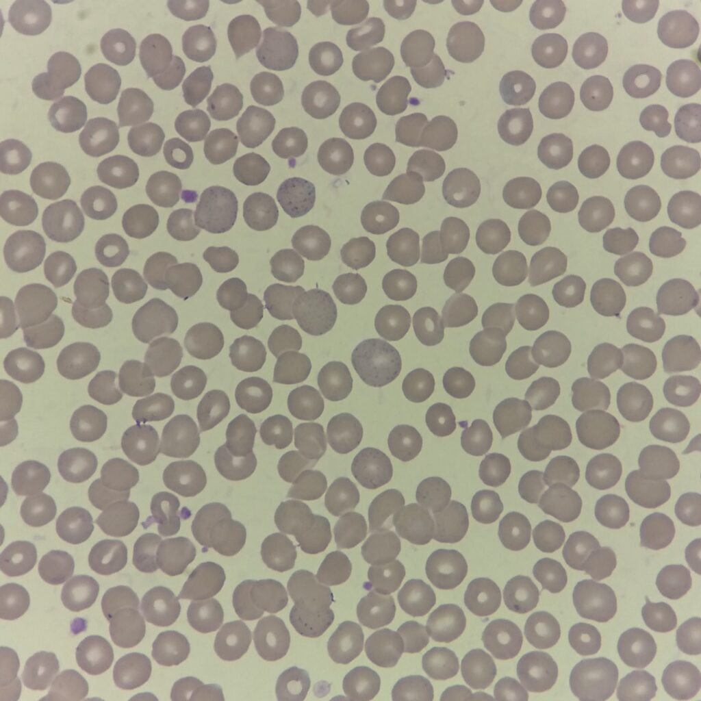 Fine basophilic stippling in polychromatophilic RBC