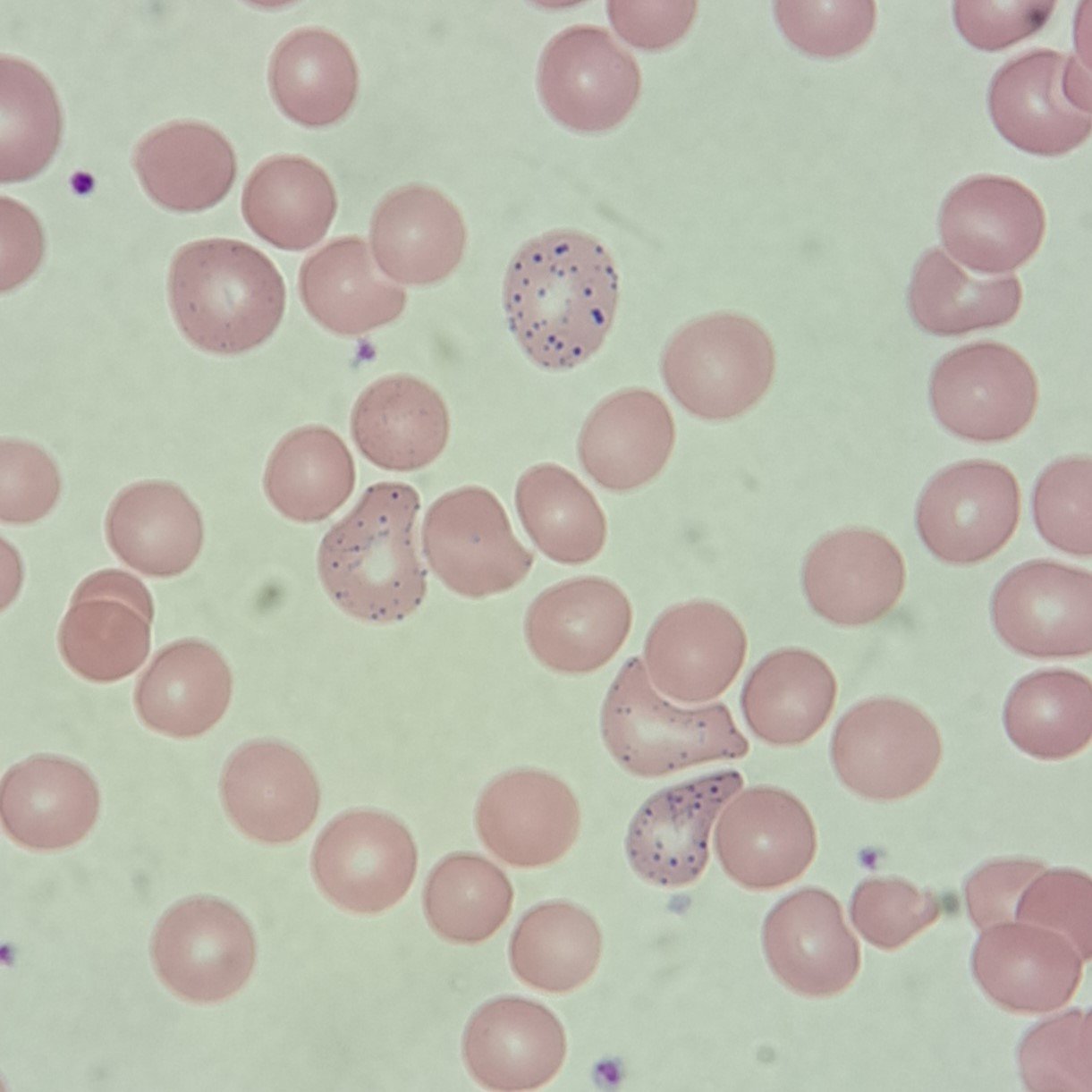 Coarse basophilic stippling in RBCs