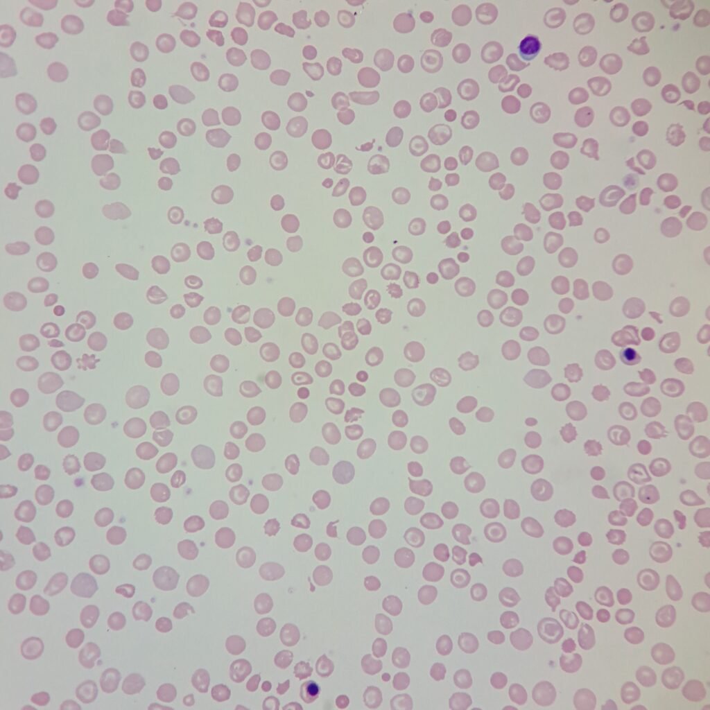 Target Cells, NRBCs, Spherocytes