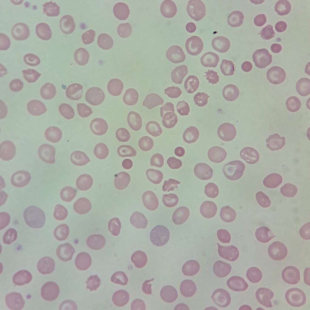 Target Cells, NRBCs, Spherocytes