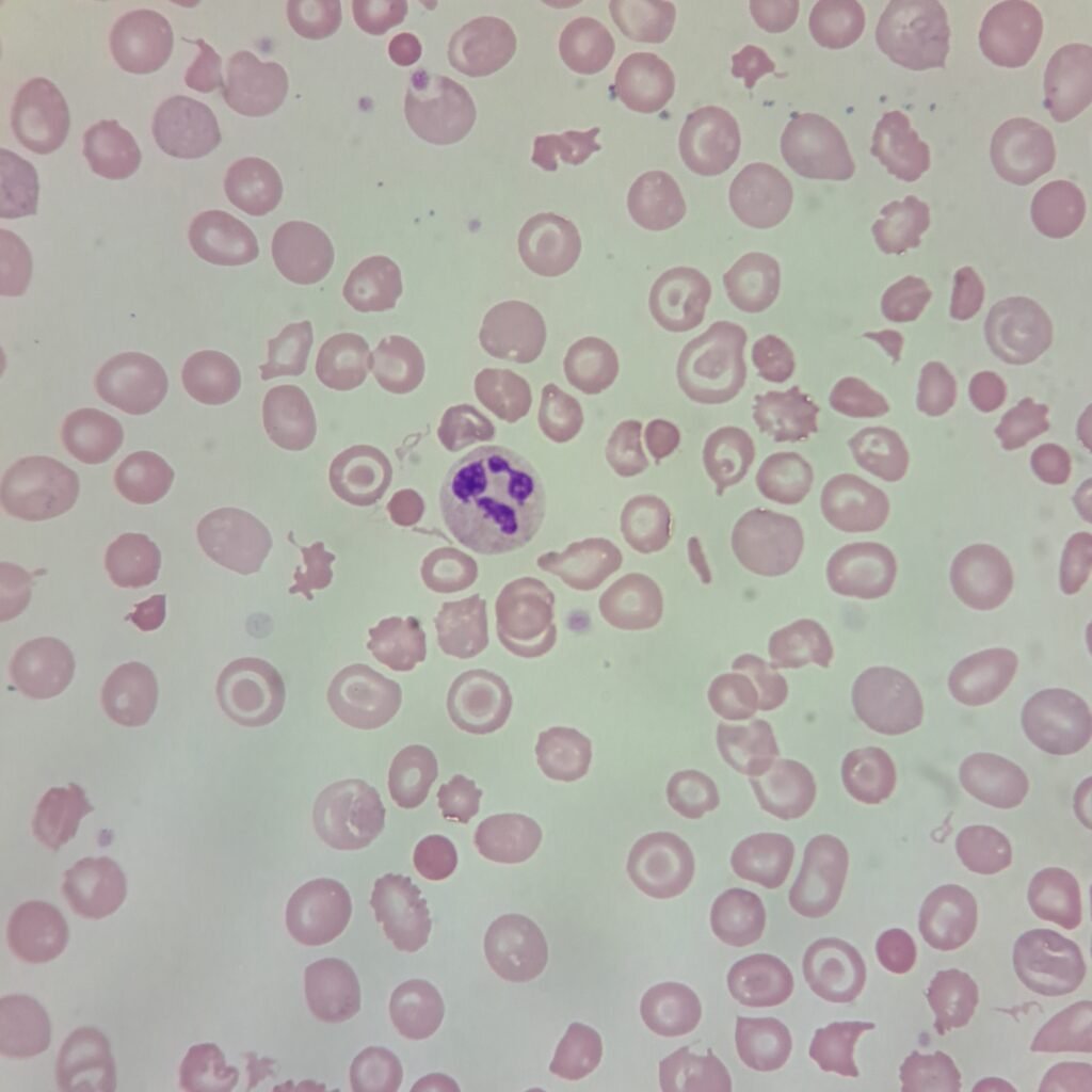 Target Cells, Spherocytes