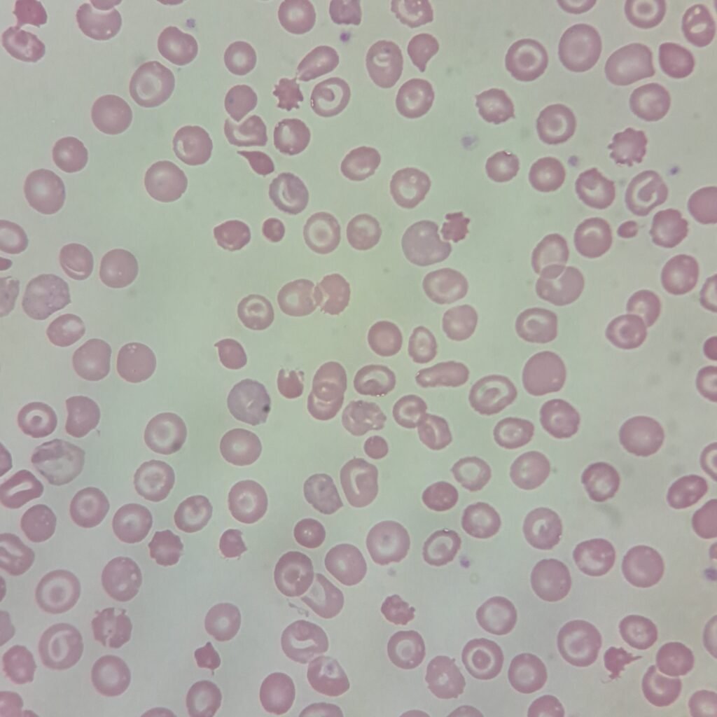 Target Cells, Spherocytes