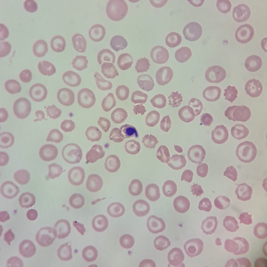 Target Cells, NRBCs, Spherocytes