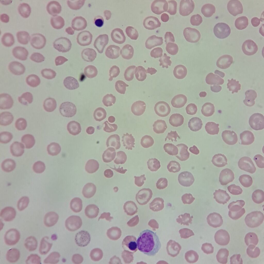 Target Cells, NRBCs, Spherocytes